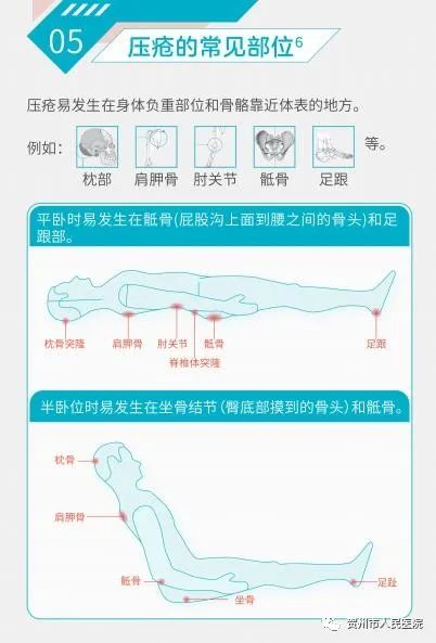 关于压疮预防与管理的最新指南，聚焦2016年更新